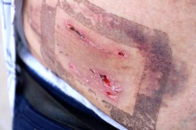 Kaldığı otelde pitbull cinsi iki köpeğin saldırısına uğradı! 40 dikiş atılıp, 100 iğne vuruldu