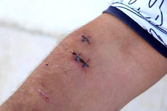 Kaldığı otelde pitbull cinsi iki köpeğin saldırısına uğradı! 40 dikiş atılıp, 100 iğne vuruldu