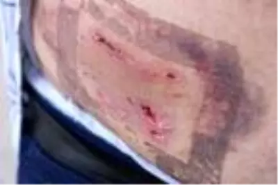 Kaldığı otelde pitbull cinsi iki köpeğin saldırısına uğradı! 40 dikiş atılıp, 100 iğne vuruldu