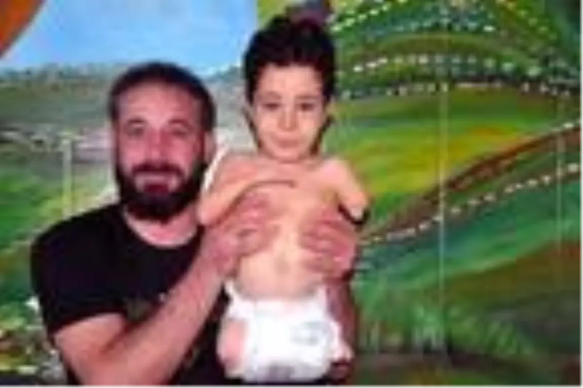 2 bacağı ve 1 kolu olmayan minik Mustafa, protez istiyor