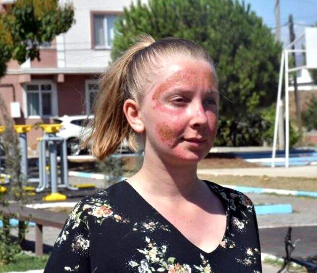 Cilt bakımı yaptırdı, yüzünde 2'nci derece yanık oluştu