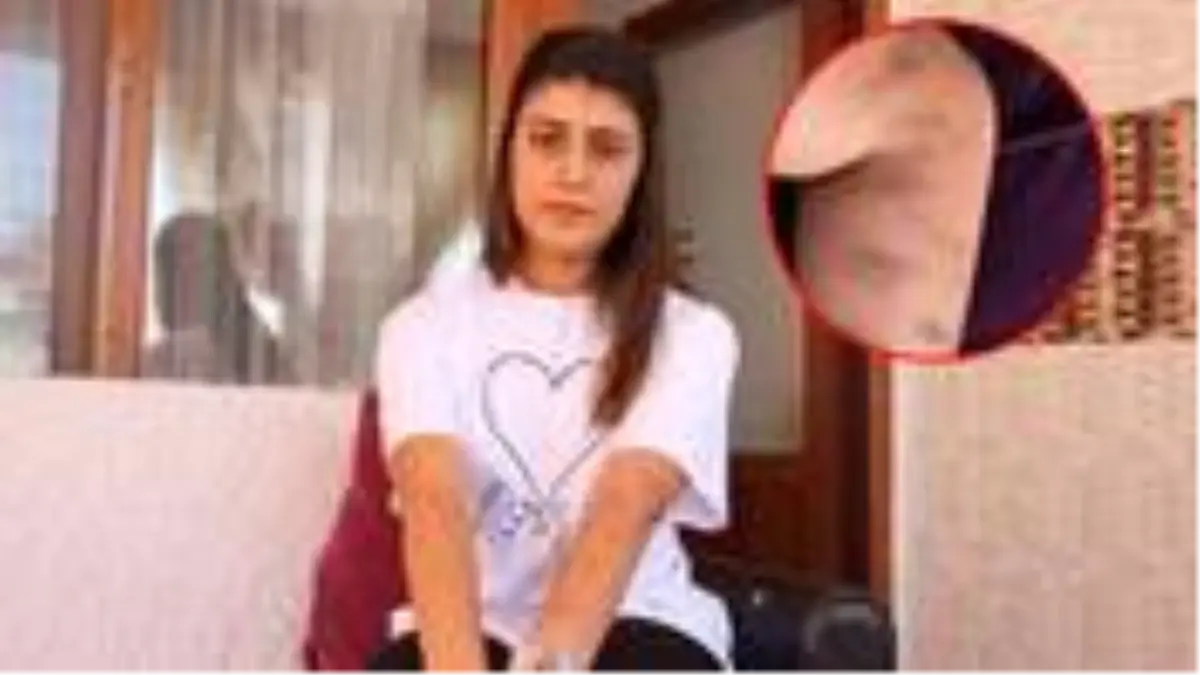 Güzellik merkezinde lazer işlemi yaptıran genç kızın kolu yandı