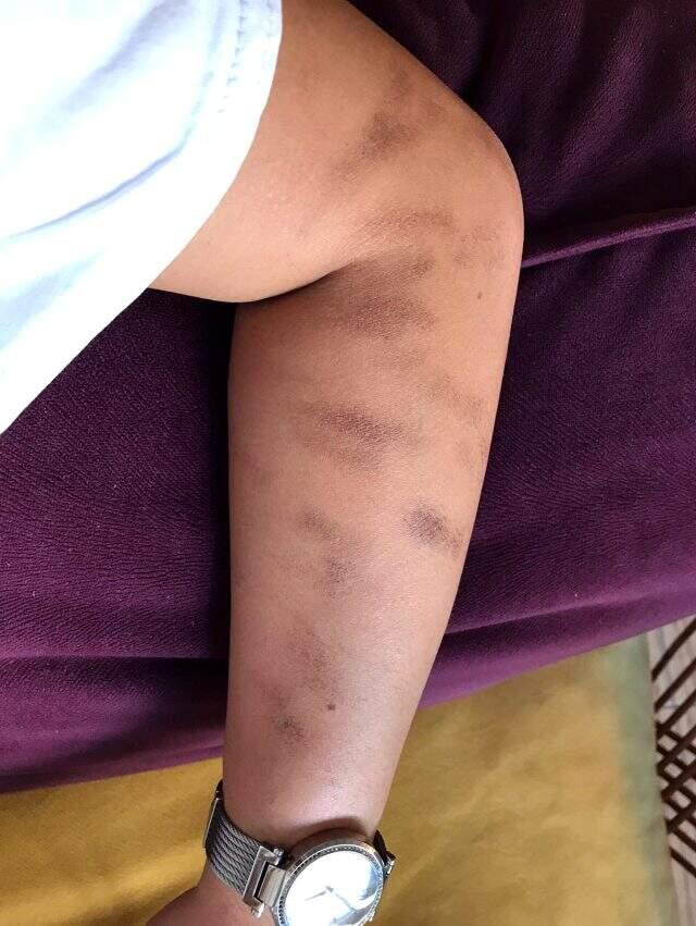 Güzellik merkezinde lazer işlemi yaptıran genç kızın kolu yandı