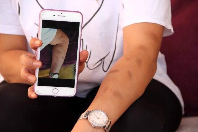 Güzellik merkezinde lazer işlemi yaptıran genç kızın kolu yandı