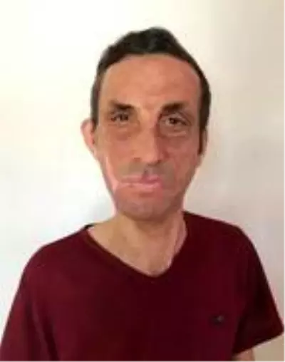 ANTALYA İlk yüz nakilli Uğur Acar Koronavirüs nedeniyle 3 ay evden çıkmadım ANTALYA İlk yüz nakilli Uğur Acar Koronavirüs nedeniyle 3 ay evden çıkmadım