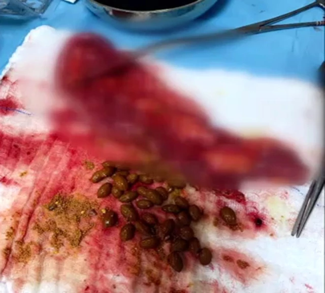 Karın ağrısı şikayetiyle hastaneye giden adamın karnından 50 adet zeytin çekirdeği çıkarıldı