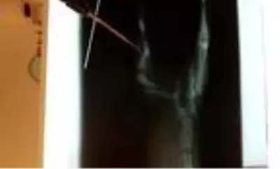Bacağı iki yerden kırık sokak kedisine tedavi Bacağı iki yerden kırık sokak kedisine tedavi