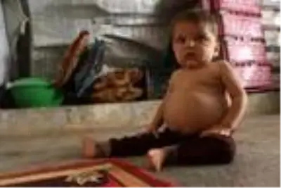 Karaciğer yetmezliği bulunan 2 yaşındaki Saad, Türkiye'de tedavi ediliyor Karaciğer yetmezliği bulunan 2 yaşındaki Saad, Türkiye'de tedavi ediliyor