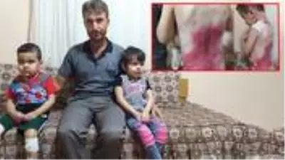Kelebek hastası çocuklarına dokunamayan anne-babanın tek bir isteği var Kelebek hastası çocuklarına dokunamayan anne-babanın tek bir isteği var