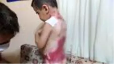 Kelebek hastası çocuklarına dokunamaya anne-babanın bir isteği var Kelebek hastası çocuklarına dokunamaya anne-babanın bir isteği var