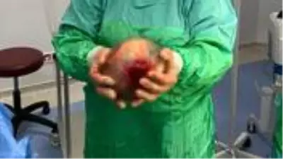 Kasık ağrısıyla hastaneye kaldırıldı, rahminden 1,5 kiloluk kist çıktı Kasık ağrısıyla hastaneye kaldırıldı, rahminden 1,5 kiloluk kist çıktı