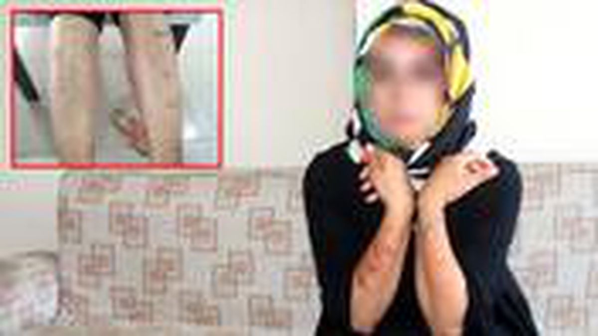 Lazer yaptırmak isterken canından oluyordu! Talihsiz kadının vücudu yandı