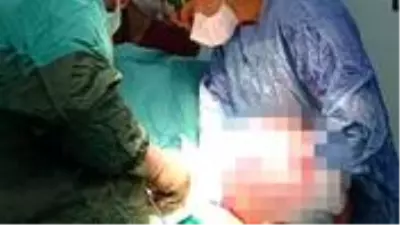 Karın ağrısı değil 5.5 kilo ağırlığında tümör çıktı Karın ağrısı değil 5.5 kilo ağırlığında tümör çıktı