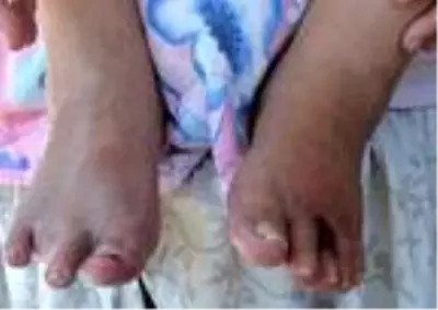 Bacağını kaybetti, gençleri uyardı: Benden ibret alın ve sigarayı bırakın Bacağını kaybetti, gençleri uyardı: Benden ibret alın ve sigarayı bırakın