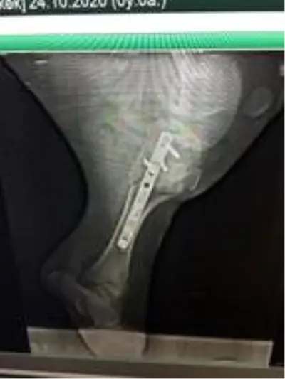 Kayseri'de bacağı kırılan buzağıya platin takıldı Kayseri'de bacağı kırılan buzağıya platin takıldı