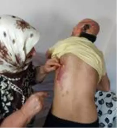 Son dakika haberleri! İlk ameliyatı olup iyileşti, sıradaki operasyonları bekliyor Son dakika haberleri! İlk ameliyatı olup iyileşti, sıradaki operasyonları bekliyor