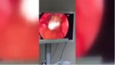 Yakalanmamak için yuttuğu uyuşturucu endoskopi ile çıkartıldı Yakalanmamak için yuttuğu uyuşturucu endoskopi ile çıkartıldı