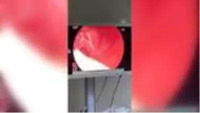 Yakalanmamak için yuttuğu uyuşturucu endoskopi ile çıkartıldı Yakalanmamak için yuttuğu uyuşturucu endoskopi ile çıkartıldı
