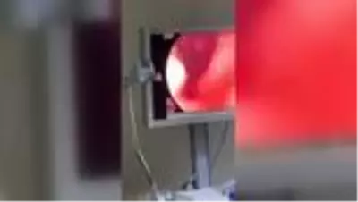 Yakalanmamak için yuttuğu uyuşturucu endoskopi ile çıkartıldı Yakalanmamak için yuttuğu uyuşturucu endoskopi ile çıkartıldı