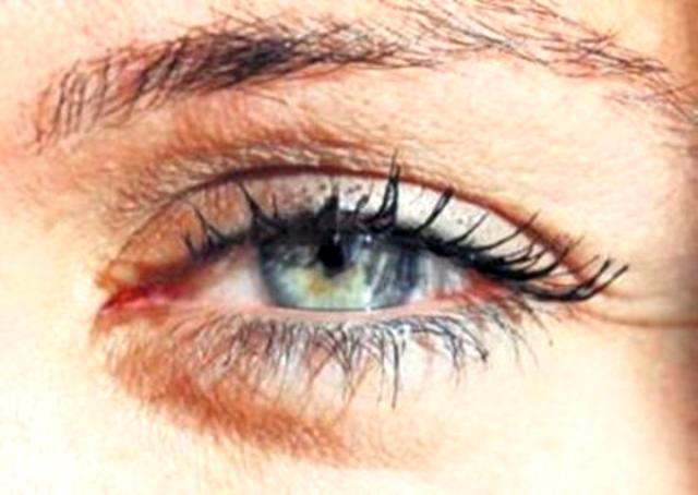 Sağ göz seğirmesi nedir, neden olur? Sol göz seğirmesi nedir? Göz seğirmesi neden olur? Nasıl geçer? Tedavisi var mı?