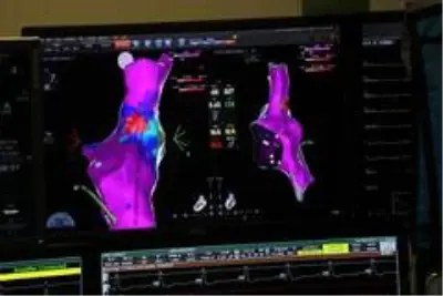 Kalpte 'kaçak elektrik yolları' yakılarak tedavi ediliyor Kalpte 'kaçak elektrik yolları' yakılarak tedavi ediliyor