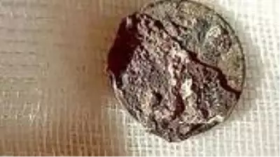 6 yaşında burnuna soktuğu bozuk para 53 yıl sonra çıkarıldı 6 yaşında burnuna soktuğu bozuk para 53 yıl sonra çıkarıldı