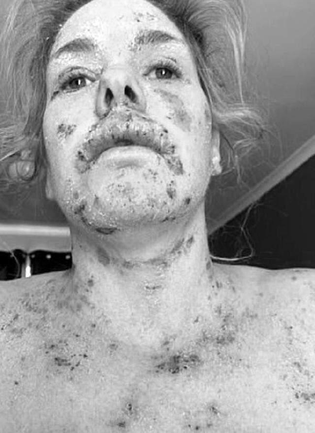 İşini kaybetti, aylarca evden çıkamadı! Egzama kremi tüm vücudunda yara çıkmasına neden oldu İşini kaybetti, aylarca evden çıkamadı! Egzama kremi tüm vücudunda yara çıkmasına neden oldu