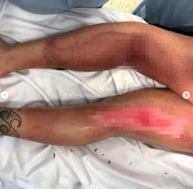 Akıl almaz olay! Soğuktan vücudu yanan ünlü dövüşçü bacaklarını kaybediyordu