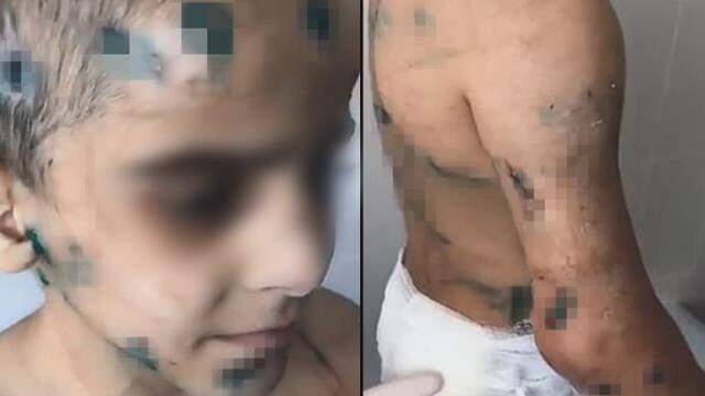 Halası tarafından 6 ay boyunca dövüldüğü için kangren olan küçük kızın kolu kurtarılamadı
