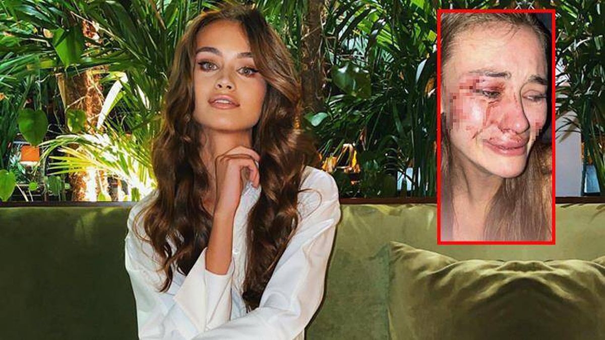 Eğlence mekanında darbedilen Ukraynalı Model Daria Kyryliuk, çalışanların özrünü kabul etti