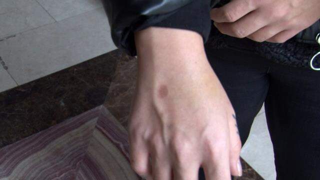 Ayrılmak istediği erkek arkadaşı tarafından darp edilen genç kadın: Ölmek istemiyorum