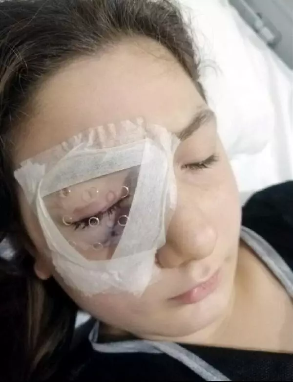 Yastık savaşında gözünden yaralanan Belinay, sağlığına kavuştu Yastık savaşında gözünden yaralanan Belinay, sağlığına kavuştu