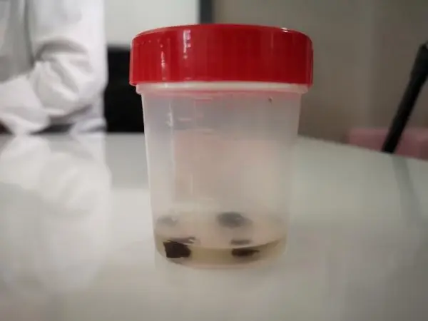 Kanser sandılar, biyopsi bile yapıldı;akciğerinden 32 yıl sonra çam fıstığı çıktı Kanser sandılar, biyopsi bile yapıldı;akciğerinden 32 yıl sonra çam fıstığı çıktı