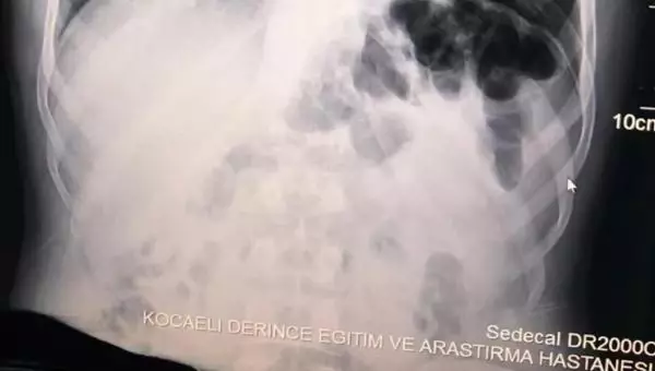 İranlı yolcuların midesinden 871 gram metamfetamin çıktı İranlı yolcuların midesinden 871 gram metamfetamin çıktı
