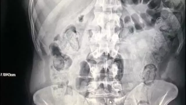 Midesinde uyuşturucu taşıyan 3 İranlı yakalandı Midesinde uyuşturucu taşıyan 3 İranlı yakalandı