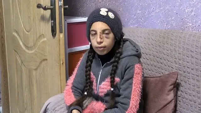 Yahudi yerleşimcilerin saldırısından zor kurtulan Filistinli küçük kız korku içinde yaşıyor Yahudi yerleşimcilerin saldırısından zor kurtulan Filistinli küçük kız korku içinde yaşıyor