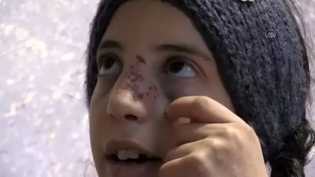 Yahudi yerleşimcilerin saldırısından zor kurtulan Filistinli küçük kız korku içinde yaşıyor Yahudi yerleşimcilerin saldırısından zor kurtulan Filistinli küçük kız korku içinde yaşıyor