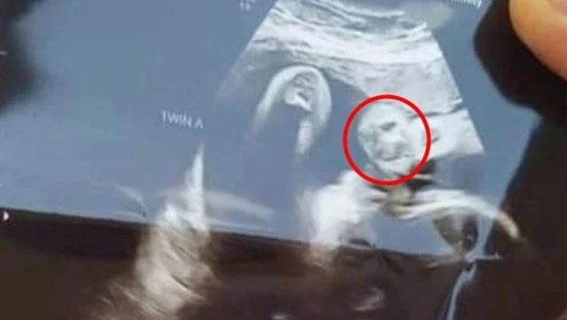 Ultrasonda bebeğinin yüzünde kaybettiği büyükbabasının yüzünü gören hamile kadın, şoke oldu