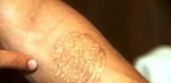 Evde Dovme Silme Islemi Nasil Yapilir Limon Ve Tuz Ile Dovme Silmek Mumkun Mu Haberler