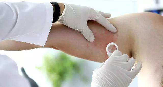 Ürtiker nedir? Ürtiker hastalığı belirtileri neler, bulaşıcı mı, tedavasi var mı? Ürtiker nedir? Ürtiker hastalığı belirtileri neler, bulaşıcı mı, tedavasi var mı?