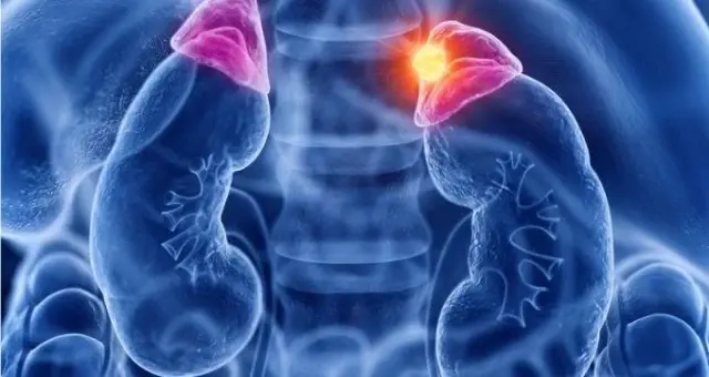 Cushing (Kuşing) hastalığı nedir? Cushing sendromu belirtileri, nedenleri nelerdir, tanısı nasıl konulur? Tedavi yöntemleri nelerdir? Cushing (Kuşing) hastalığı nedir? Cushing sendromu belirtileri, nedenleri nelerdir, tanısı nasıl konulur? Tedavi yöntemleri nelerdir?