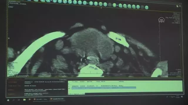 ZONGULDAK - 3,5 saatlik operasyonla boynundaki kitle alınan guatr hastası oksijen tüpünden kurtuldu ZONGULDAK - 3,5 saatlik operasyonla boynundaki kitle alınan guatr hastası oksijen tüpünden kurtuldu