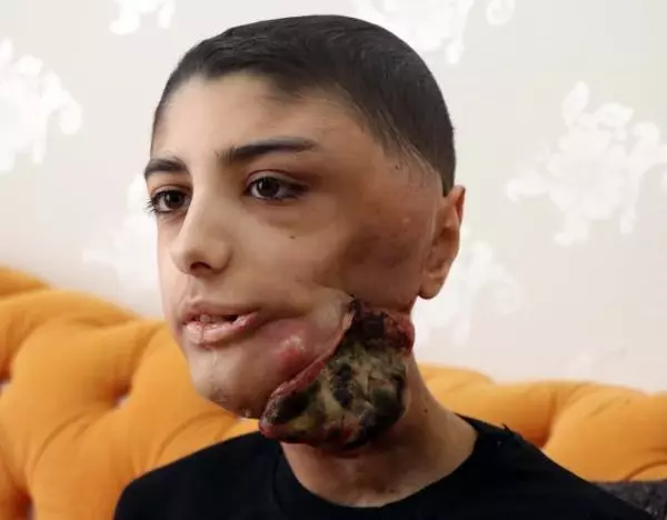 Yüzünde çıkan tümör sonrası kapanmayan yara her gün büyüyor Yüzünde çıkan tümör sonrası kapanmayan yara her gün büyüyor