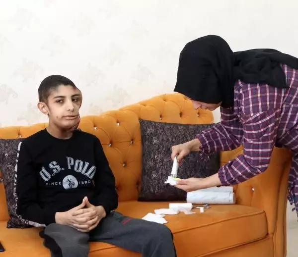 Yüzünde çıkan tümör sonrası kapanmayan yara her gün büyüyor Yüzünde çıkan tümör sonrası kapanmayan yara her gün büyüyor
