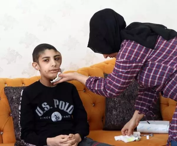 Yüzünde çıkan tümör sonrası kapanmayan yara her gün büyüyor Yüzünde çıkan tümör sonrası kapanmayan yara her gün büyüyor
