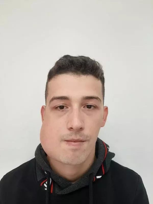 Yüzündeki dev tümörden 'sanal ameliyat' ile kurtuldu Yüzündeki dev tümörden 'sanal ameliyat' ile kurtuldu