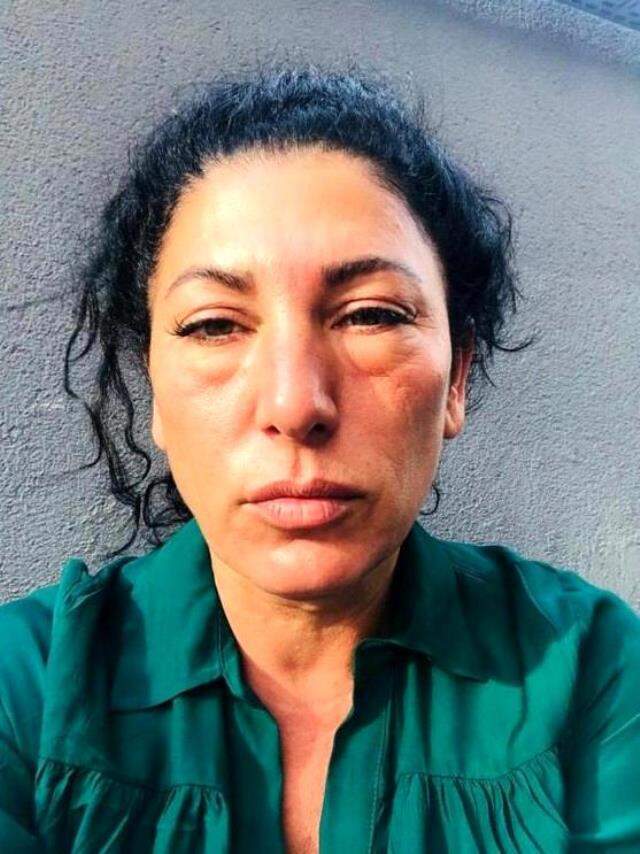 Gözaltı dolgusu yaptıran kadın tanınmaz hale geldi