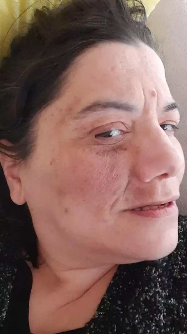 Damak tedavisinde sinir kesilince yüz felci oldu Damak tedavisinde sinir kesilince yüz felci oldu