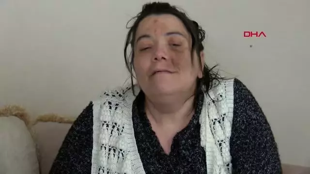 KOCAELİ Damak tedavisinde sinir kesilince yüz felci oldu KOCAELİ Damak tedavisinde sinir kesilince yüz felci oldu