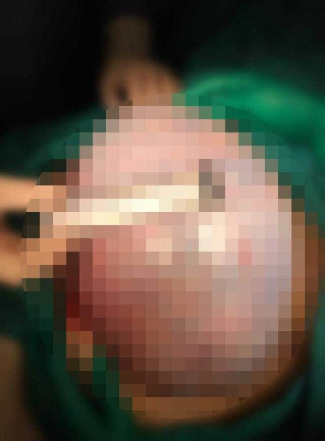 Ağrı şikayetiyle hastaneye giden kadının yumurtalığından 20 kilo kitle çıktı Ağrı şikayetiyle hastaneye giden kadının yumurtalığından 20 kilo kitle çıktı